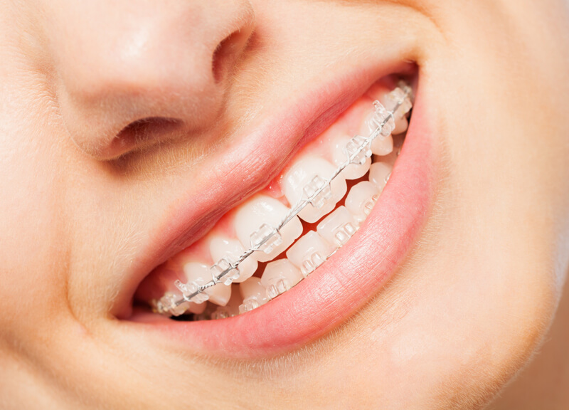 Fast teeth straightening treatment