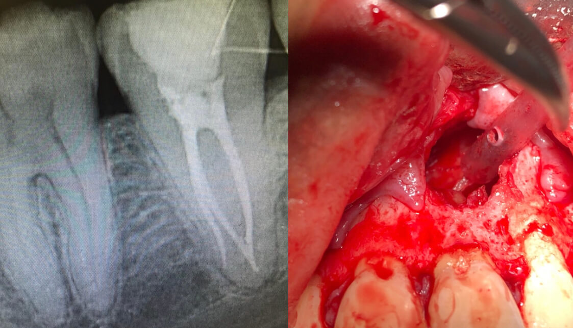 The importance of identifying the correct endodontic treatment to save a tooth
